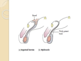 Congenital Anomalies of Anterior Abdominal wall By Dr Hatem Elgohary