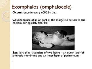 (omphalocele)Exomphalos
Occurs once in every 6000 births.
Cause: failure of all or part of the midgut to return to the
coelom during early fetal life.
Sac: very thin, it consists of two layers – an outer layer of
amniotic membrane and an inner layer of peritoneum.
.
 