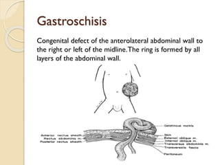 Gastroschisis
Congenital defect of the anterolateral abdominal wall to
the right or left of the midline.The ring is formed by all
layers of the abdominal wall.
 