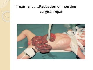 Treatment ….Reduction of intestine
Surgical repair
 