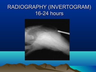 RADIOGRAPHY (INVERTOGRAM)RADIOGRAPHY (INVERTOGRAM)
16-24 hours16-24 hours
 