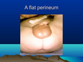 A flat perineumA flat perineum
 