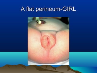 A flat perineum-GIRLA flat perineum-GIRL
 