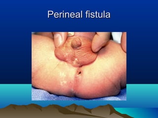 Perineal fistulaPerineal fistula
 