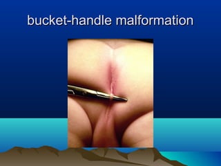 bucket-handle malformationbucket-handle malformation
 