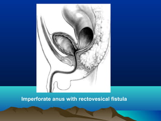 Imperforate anus with rectovesical fistula
 