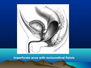 Imperforate anus with rectourethral fistula
 