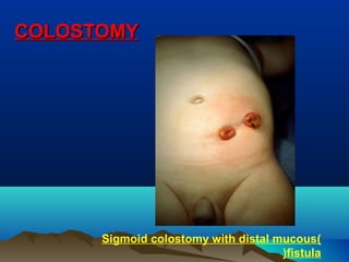 COLOSTOMYCOLOSTOMY
)Sigmoid colostomy with distal mucous
fistula(
 