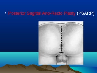 • Posterior Sagittal Ano-Recto Plasty (PSARP)
 