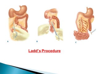 Ladd′s Procedure
 