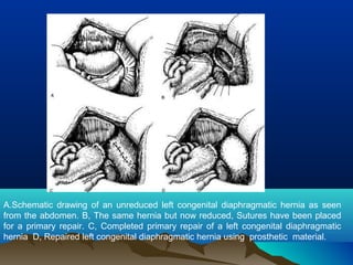 A.Schematic drawing of an unreduced left congenital diaphragmatic hernia as seen
from the abdomen. B, The same hernia but now reduced, Sutures have been placed
for a primary repair. C, Completed primary repair of a left congenital diaphragmatic
hernia D, Repaired left congenital diaphragmatic hernia using prosthetic material.
 