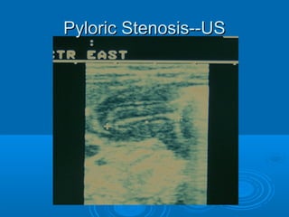 Pyloric Stenosis--USPyloric Stenosis--US
 