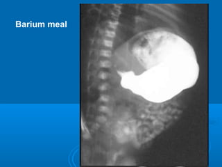 Barium meal
 
