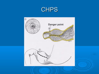 CHPSCHPS
Danger point
 