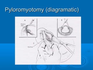 Pyloromyotomy (diagramatic)Pyloromyotomy (diagramatic)
 