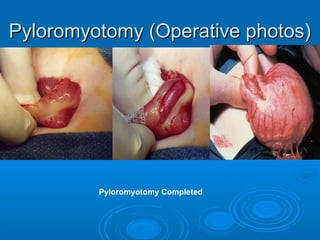 Pyloromyotomy (Operative photos)Pyloromyotomy (Operative photos)
Pyloromyotomy Completed
 