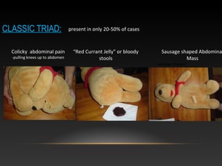 CLASSIC TRIAD:
Colicky abdominal pain
-pulling knees up to abdomen
Sausage shaped Abdomina
Mass
-sausage shaped
“Red Currant Jelly” or bloody
stools
present in only 20-50% of cases
 