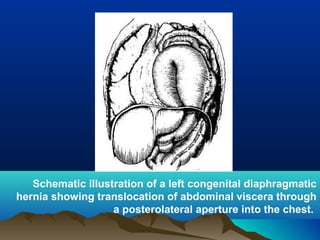 Schematic illustration of a left congenital diaphragmatic
hernia showing translocation of abdominal viscera through
a posterolateral aperture into the chest.
 