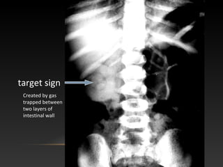 Created by gas
trapped between
two layers of
intestinal wall
target sign
 