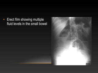 • Erect film showing multiple
fluid levels in the small bowel
 