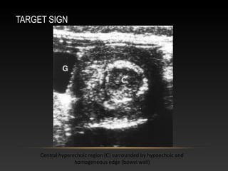 TARGET SIGN
Central hyperechoic region (C) surrounded by hypoechoic and
homogeneous edge (bowel wall)
 
