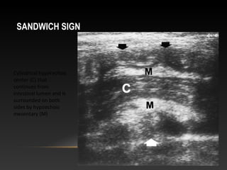 SANDWICH SIGN
Cylindrical hyperechoic
center (C) that
continues from
intestinal lumen and is
surrounded on both
sides by hypoechoic
mesentary (M)
 