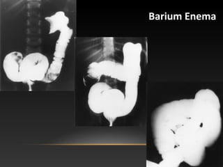 Barium Enema:
 