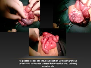 Neglected ileocecal intussusception with gangrenous
perforated intestines treated by resection and primary
anastmosis
 
