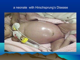 a neonate with Hirschsprung’s Disease
 