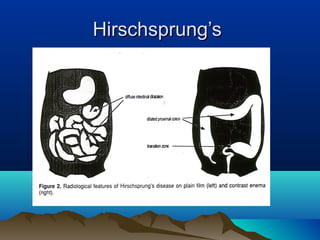 Hirschsprung’sHirschsprung’s
 