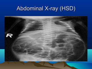 Abdominal X-ray (HSD)Abdominal X-ray (HSD)
 