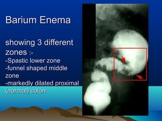 Barium EnemaBarium Enema
showing 3 differentshowing 3 different
zoneszones :-:-
-Spastic lower zone-Spastic lower zone
-funnel shaped middle-funnel shaped middle
zonezone
-markedly dilated proximal-markedly dilated proximal
(normal) colon(normal) colon
 