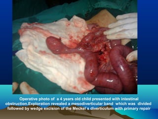 Operative photo of a 4 years old child presented with intestinal
obstruction.Exploration revealed a mesodiverticular band which was divided
followed by wedge excision of the Meckel`s diverticulum with primary repair
 