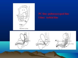 PC line: pubococcygeal line
I line: ischial line
 