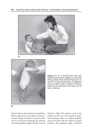 90  Pediatric Swallowing and Feeding: Assessment and Management
Passive flexion and extension of shoulders,
elbows, hips, knees, and ankles can be per-
formed. Range of motion of various joints
can be measured including the anterior
scarf and popliteal angles (Amiel-Tison 
Gremier, 1986). The anterior scarf is the
position of the arm at the point of maxi-
mal resistance when it is pulled medially
across the chest with the infant in supine
position. The popliteal angle is formed
Figure 3–1. A. A 10-month-old infant with
cerebral palsy (spastic diplegia). In supported
sitting, excessive hip and knee flexion can be
seen. B. In supported standing, an obligatory
positive support reflex is present. Extensor
posturing and adduction of the legs can be
seen. continues
B
A
 