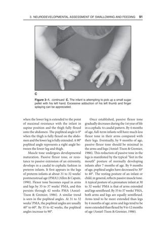 3. Neurodevelopmental Assessment of Swallowing and Feeding  91
when the lower leg is extended to the point
of maximal resistance with the infant in
supine position and the thigh fully flexed
onto the abdomen. The popliteal angle is 0°
when the thigh is fully flexed on the abdo-
menandthelowerlegisfullyextended.A90°
popliteal angle represents a right angle be-
tween the lower leg and thigh.
Muscle tone undergoes developmental
maturation. Passive flexor tone, or resis-
tance to passive extension of an extremity,
develops in a caudal to cephalic fashion in
preterm infants. It first appears in the legs
of preterm infants at about 31 to 32 weeks’
postmenstrual age (PMA) (Allen  Capute,
1990). Flexor tone becomes equal in arms
and legs by 35 to 37 weeks’ PMA, and this
persists through 42 weeks PMA (Amiel-
Tison  Gremier, 1986). A similar trend
is seen in the popliteal angles. At 31 to 32
weeks’ PMA, the popliteal angles are usually
40° to 60°. By 35 to 42 weeks, the popliteal
angles increase to 90°.
Once established, passive flexor tone
gradually decreases during the 1st year of life
in a cephalic to caudal pattern. By 4 months
of age, full-term infants will have much less
flexor tone in their arms compared with
their legs. Eventually, by 9 months of age,
passive flexor tone should be minimal in
the arms and legs (Amiel-Tison  Gremier,
1986). This reduction of passive tone in the
legs is manifested by the typical “feet in the
mouth” posture of normally developing
infants after 7 months of age. By 9 months
of age, popliteal angles have decreased to 30°
to 40°. The resting posture of an infant or
child, in general, reflects passive muscle tone.
A typical posture of a premature infant at 30
to 32 weeks’ PMA is that of arms extended
and legs semiflexed. By 35 to 37 weeks’ PMA,
both arms and legs are equally semiflexed.
Arms tend to be more extended than legs
by 4 months of age; arms and legs tend to be
more extended than flexed by 9 to 12 months
of age (Amiel-Tison  Gremier, 1986).
C
Figure 3–1. continued  
C. The infant is attempting to pick up a small sugar
pellet with his left hand. Excessive adduction of his left thumb and finger
splaying can be appreciated.
 