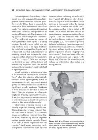 92  Pediatric Swallowing and Feeding: Assessment and Management
The development of truncal and axillary
muscle tone follows a cranial to caudal pro-
gression in the immediate postnatal years.
By 35 weeks’ PMA, there is an equal dis-
tribution of flexor and extensor tone of the
trunk. This pattern continues throughout
infancy and childhood. This pattern can be
most readily appreciated by observing rest-
ing posture and by the pull-to-sit maneu-
ver. The pull-to-sit maneuver consists of
pulling the infant from supine to a sitting
position. Typically, when pulled to a sit-
ting position, there is an equal tendency
for an infant’s head to either drop forward
or backward. Another useful maneuver in
assessing truncal tone involves the prone
suspension of an infant over the examiner’s
hand. By 35 weeks’ PMA and through-
out the first few years of life, infants will
momentarily align their trunk in a parallel
fashion with the examiner’s hand while held
in a prone position.
Muscle strength, or active muscle tone,
is the amount of resistance the examiner
“feels” when the infant or child actively
resists or moves against gravity. Active or
spontaneous extremity movements against
gravity are often diminished in infants with
significant muscle weakness. Weakness
of facial muscles can result in a “masked
facies.” Traction responses are also quite
helpful in detecting significant weakness.
A traction response represents the amount
of active resistance an infant will use when
a hand or foot is extended manually.
Observation of resting posture is ex-
tremely helpful in assessing muscle tone.
The resting posture of equal extremity flex-
ion in an infant at 36 weeks’ PMA demon-
strates normal flexor extremity tone (Fig-
ure 3–2A). Arm and leg traction responses
indicate normal muscle strength (Figure
3–2B and C). Prone suspension over the
examiner’s hand reveals momentary paral-
lel alignment of the infant’s trunk with the
examiner’s hand, indicating normal truncal
tone (Figure 3–2D). Figures 3–2E–I demon-
strate the degree of head control that can be
expected at this age, as well as the balance
of flexor and extensor tone of the trunk.
In contrast, another preterm infant at 35
weeks’ PMA shows minimal flexion of
extremities and excessive supination of arms
(Figure 3–3A). This infant also had a weak
suck and swallowing problems. A computed
tomography (CT) scan revealed possible
ischemic brain injury. Neurodevelopmental
examination revealed central and peripheral
hypotonia without significant weakness. In
prone suspension, truncal “draping” over
the examiner’s hand and noticeable arm
and leg extension are seen (Figure 3–3B).
Figure 3–3C illustrates the marked increase
in head lag of the infant when pulled to a
sitting position.
Figure 3–2. A. A 36-week postmenstrual age
infant in supine position demonstrating normal
flexor posture of arms and legs. Arms and legs
are about equally flexed. continues
A
 