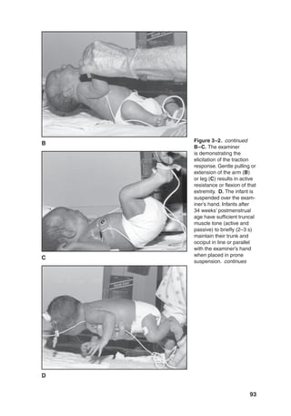 93
Figure 3–2. continued
B–C. The examiner
is demonstrating the
elicitation of the traction
response. Gentle pulling or
extension of the arm (B)
or leg (C) results in active
resistance or flexion of that
extremity. D. The infant is
suspended over the exam-
iner’s hand. Infants after
34 weeks’ postmenstrual
age have sufficient truncal
muscle tone (active and
passive) to briefly (2–3 s)
maintain their trunk and
occiput in line or parallel
with the examiner’s hand
when placed in prone
suspension. continues
C
B
D
 