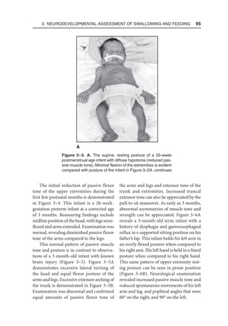 3. Neurodevelopmental Assessment of Swallowing and Feeding  95
The initial reduction of passive flexor
tone of the upper extremities during the
first few postnatal months is demonstrated
in Figure 3–4. This infant is a 26-week-
gestation preterm infant at a corrected age
of 3 months. Reassuring findings include
midline position of the head, with legs semi-
flexed and arms extended. Examination was
normal, revealing diminished passive flexor
tone of the arms compared to the legs.
This normal pattern of passive muscle
tone and posture is in contrast to observa-
tions of a 3-month-old infant with known
brain injury (Figure 3–5). Figure 3–5A
demonstrates excessive lateral turning of
the head and equal flexor posture of the
arms and legs. Excessive extensor arching of
the trunk is demonstrated in Figure 3–5B.
Examination was abnormal and confirmed
equal amounts of passive flexor tone of
the arms and legs and extensor tone of the
trunk and extremities. Increased truncal
extensor tone can also be appreciated by the
pull-to-sit maneuver. As early as 3 months,
abnormal asymmetries of muscle tone and
strength can be appreciated. Figure 3–6A
reveals a 3-month-old term infant with a
history of dysphagia and gastroesophageal
reflux in a supported sitting position on his
father’s lap. This infant holds his left arm in
an overly flexed posture when compared to
his right arm. His left hand is held in a fisted
posture when compared to his right hand.
This same pattern of upper extremity rest-
ing posture can be seen in prone position
(Figure 3–6B). Neurological examination
revealed increased passive muscle tone and
reduced spontaneous movements of his left
arm and leg, and popliteal angles that were
60° on the right, and 90° on the left.
Figure 3–3. A. The supine, resting posture of a 35-week
postmenstrual age infant with diffuse hypotonia (reduced pas-
sive muscle tone). Minimal flexion of the extremities is evident
compared with posture of the infant in Figure 3–2A. continues
A
 