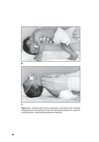 96
Figure 3–3. continued  
B. In prone suspension, the infant’s trunk is draped
excessively over the examiner’s hand. C. Infant being pulled from supine to
a sitting position, demonstrating excessive head lag.
C
B
 