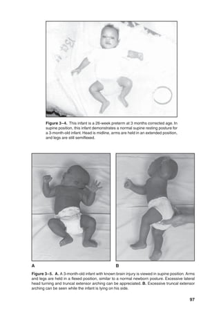 97
Figure 3–4. This infant is a 26-week preterm at 3 months corrected age. In
supine position, this infant demonstrates a normal supine resting posture for
a 3-month-old infant. Head is midline, arms are held in an extended position,
and legs are still semiflexed.
Figure 3–5. A. A 3-month-old infant with known brain injury is viewed in supine position. Arms
and legs are held in a flexed position, similar to a normal newborn posture. Excessive lateral
head turning and truncal extensor arching can be appreciated. B. Excessive truncal extensor
arching can be seen while the infant is lying on his side.
A B
 