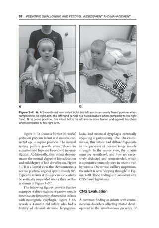 98  Pediatric Swallowing and Feeding: Assessment and Management
Figure 3–7A shows a former 30-weeks’
gestation preterm infant at 6 months cor-
rected age in supine position. The normal
resting posture reveals arms relaxed in
extension and hips and knees held in semi-
flexion. Additionally, this infant demon-
strates the normal degree of hip adduction
and mild degree of foot dorsiflexion. Figure
3–7B is a lateral view that demonstrates a
normal popliteal angle of approximately 60°.
Typically, infants at this age can successfully
be vertically suspended under their axillae
as shown in Figure 3–7C.
The following figures provide further
examples of abnormalities of passive muscle
tone that are frequently observed in infants
with neurogenic dysphagia. Figure 3–8A
reveals a 4-month-old infant who had a
history of choanal stenosis, laryngoma-
lacia, and neonatal dysphagia eventually
requiring a gastrostomy tube. On exami-
nation, this infant had diffuse hypotonia
in the presence of normal range muscle
strength. In the supine view, the infant’s
arms are semiflexed, and hips are exces-
sively abducted and semiextended, which
is a posture commonly seen in infants with
hypotonia. On vertical axillary suspension,
the infant is seen “slipping through” in Fig-
ure 3–8B. These findings are consistent with
CNS-based hypotonia.
CNS Evaluation
A common finding in infants with central
nervous disorders affecting motor devel-
opment is the simultaneous presence of
Figure 3–6. A. A 3-month-old term infant holds his left arm in an overly flexed posture when
compared to his right arm. His left hand is held in a fisted posture when compared to his right
hand. B. In prone position, this infant holds his left arm in more flexion and against his chest
when compared to his right arm.
A B
 