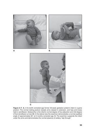 99
Figure 3–7. A. A 6-month corrected age former 30-week gestation preterm infant in supine
position. The normal resting posture reveals arms relaxed in extension, and hips and knees
held in semiflexion. Noteworthy is the infant’s normal degree of hip adduction and mild degree
of foot dorsiflexion at rest. B. In this lateral view the examiner demonstrates a normal popliteal
angle of approximately 60° at 6 months corrected age. C. The examiner suspends the infant
under the arms and demonstrates the normal absence of axillary “slip through.”
C
A B
 