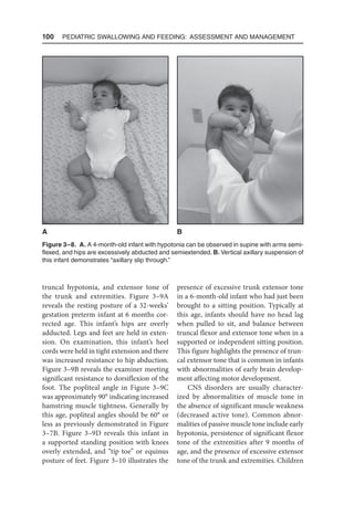 100  Pediatric Swallowing and Feeding: Assessment and Management
truncal hypotonia, and extensor tone of
the trunk and extremities. Figure 3–9A
reveals the resting posture of a 32-weeks’
gestation preterm infant at 6 months cor-
rected age. This infant’s hips are overly
adducted. Legs and feet are held in exten-
sion. On examination, this infant’s heel
cords were held in tight extension and there
was increased resistance to hip abduction.
Figure 3–9B reveals the examiner meeting
significant resistance to dorsiflexion of the
foot. The popliteal angle in Figure 3–9C
was approximately 90° indicating increased
hamstring muscle tightness. Generally by
this age, popliteal angles should be 60° or
less as previously demonstrated in Figure
3–7B. Figure 3–9D reveals this infant in
a supported standing position with knees
overly extended, and “tip toe” or equinus
posture of feet. Figure 3–10 illustrates the
presence of excessive trunk extensor tone
in a 6-month-old infant who had just been
brought to a sitting position. Typically at
this age, infants should have no head lag
when pulled to sit, and balance between
truncal flexor and extensor tone when in a
supported or independent sitting position.
This figure highlights the presence of trun-
cal extensor tone that is common in infants
with abnormalities of early brain develop-
ment affecting motor development.
CNS disorders are usually character-
ized by abnormalities of muscle tone in
the absence of significant muscle weakness
(decreased active tone). Common abnor-
malities of passive muscle tone include early
hypotonia, persistence of significant flexor
tone of the extremities after 9 months of
age, and the presence of excessive extensor
tone of the trunk and extremities. Children
Figure 3–8. A. A 4-month-old infant with hypotonia can be observed in supine with arms semi-
flexed, and hips are excessively abducted and semiextended. B. Vertical axillary suspension of
this infant demonstrates “axillary slip through.”
A B
 