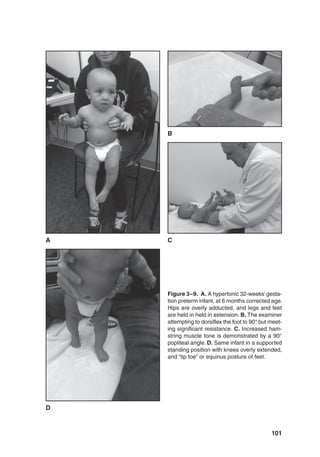 101
Figure 3–9. A. A hypertonic 32-weeks’gesta-
tion preterm infant, at 6 months corrected age.
Hips are overly adducted, and legs and feet
are held in held in extension. B. The examiner
attempting to dorsiflex the foot to 90° but meet-
ing significant resistance. C. Increased ham-
string muscle tone is demonstrated by a 90°
popliteal angle. D. Same infant in a supported
standing position with knees overly extended,
and “tip toe” or equinus posture of feet.
D
A
B
C
 
