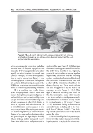 102  Pediatric Swallowing and Feeding: Assessment and Management
with neuromuscular disorders including
anterior horn cell diseases, myopathies, and
muscular dystrophies generally have rather
significant reductions in active muscle tone
(muscle strength) and less striking reduc-
tion in passive muscle tone. Table 3–4 con-
tains key physical examination findings that
are useful in differentiating disorders of the
CNS from neuromuscular conditions that
result in swallowing and feeding problems.
CP is a condition that results from a
static nonprogressive cerebral lesion that
occurs during the developmental period of
early childhood and is manifested by motor
delays, abnormal neuromotor findings, and
a high prevalence of other CNS deficits in
areas of cognition and neurobehavior. CP
is one of the most common causes of neu-
rogenic dysphagia. The resting posture of a
27-month-old girl with CP reveals excessive
flexion of her arms and predominant exten-
sor posturing of her legs (Figure 3–11A).
These findings reflect increased passive
flexor tone of the arms and passive exten-
sor tone of the legs. Figure 3–11B illustrates
the normal resting posture of children after
the first 9 to 12 months of life. Typically,
passive flexor tone of the arms and legs has
significantly decreased, and the resulting
posture consists of only minimal flexion of
the extremities. Passive extensor tone and
posture of the extremities should not be
observed at any age. These abnormalities
can also be appreciated by the pull-to-sit
maneuver seen in Figure 3–11C–E. This
type of extensor posturing can result in
the child coming to a stand rather than to
a sit. Abnormally increased passive muscle
tone in the lower extremities usually results
in popliteal angles of 90° or more (Figure
3–11F). A common finding in children with
cerebral injuries including CP is the “cor-
tical thumb” (Figure 3–11G). This find-
ing consists of the adduction of the thumb
across the palm.
An 8-month-old girl with myotonic dys-
trophy provides further illustrations of find-
ings important in a physical examination.
Figure 3–10. A 6-month-old infant with excessive neck and trunk extensor
tone has been brought up to a sitting position. Extensor posturing of the neck
and trunk can be appreciated.
 