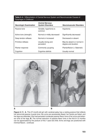 103
Figure 3–11. A. This 27-month-old girl with cerebral palsy has a resting posture that reflects
her abnormal passive muscle tone. Her arms are excessively flexed, her hands are fisted, and
her legs are extended. She had persistent moderate passive flexor tone of her arms and exten-
sor tone of her legs. B. The normal reduction of passive flexor tone in the first 9–12 months
can be appreciated by the posture of this 1-year-old child. Arms and legs are positioned with
minimal flexion. continues
A B
Table 3–4. Differentiation of Central Nervous System and Neuromuscular Causes of
Dysphagia in Childhood
Neurologic Examination
Central Nervous
System Disorders Neuromuscular Disorders
Passive tone Variable, hypertonia is
common
Hypotonia
Active tone (strength) Normal or mildly decreased Significantly decreased
Deep tendon reflexes Normal or increased Decreased or absent
Primitive reflexes Usually strong and
persistent
May be absent or normal in
degree and duration
Plantar response Commonly up-going Plantarflexion (+ Babinski)
Cognition Cognitive deficits Usually normal
 