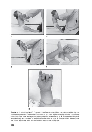 104
Figure 3–11. continued C–E. Extensor tone of the trunk and legs can be appreciated by the
pull-to-sit maneuver. Pulling this 27-month-old girl from supine to sitting results in extensor
posturing of the trunk and legs and coming to stand rather than to sit. F. This popliteal angle of
approximately 90° indicates increased hamstring muscle tone. G. The persistent adduction of
the thumb across the palm (cortical thumb) is abnormal at any age.
G
E F
C D
 