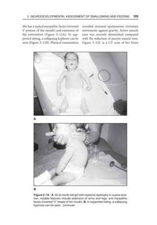 3. Neurodevelopmental Assessment of Swallowing and Feeding  105
She has a typical myopathic facies (inverted
V posture of the mouth) and extension of
the extremities (Figure 3–12A). In sup-
ported sitting, a collapsing kyphosis can be
seen (Figure 3–12B). Physical examination
revealed minimal spontaneous extremity
movements against gravity. Active muscle
tone was severely diminished compared
with the reduction of passive muscle tone.
Figure 3–12C is a CT scan of her brain
Figure 3–12. A. An 8-month-old girl with myotonic dystrophy. In supine posi-
tion, notable features include extension of arms and legs, and myopathic
facies (inverted “V” shape of her mouth). B. In supported sitting, a collapsing
kyphosis can be seen. continues
B
A
 