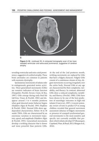 106  Pediatric Swallowing and Feeding: Assessment and Management
revealing ventricular and extra-axial promi-
nence, suggestive of cerebral atrophy. These
brain anomalies are common in patients
with myotonic dystrophy.
Spontaneous movements of infants refer
to endogenously generated motor activi-
ties. These generalized movements (GMs)
are sensitive indicators of brain function
(Einspieler, Prechtl, Ferrari, Cioni,  Bos,
1997). GMs emerge during early fetal life
(deVries, Visser,  Prechtl, 1982) and dis-
appear around 3 to 4 months postterm
when goal-directed motor behavior begins
(Hadders-Algra  Prechtl, 1993; Hopkins
 Prechtl, 1984). Normal GMs show age-
dependent characteristics. Before 36 to 38
weeks’ PMA, GMs are characterized by an
enormous variation in movement trajec-
tory, speed, and amplitude (Hadders-Algra
 Prechtl, 1993). Generalized movements
develop a writhing character that is slower
and more powerful than preterm GMs.
At the end of the 2nd postterm month,
writhing movements are replaced by GMs
that have a fidgety character. Fidgety GMs
consist of a continuous stream of tiny, ele-
gant movements occurring irregularly over
the entire body. Normal GMs at any age
are characterized by their complexity, vari-
ability, and fluency. In contrast, abnormal
GMs show a reduced complexity, variabil-
ity, and fluency (Prechtl, 1990). GMs have
been shown to be one of the best predic-
tors of neurologic outcomes in high-risk
infants (Cioni et al., 1997). A recent system-
atic review of tests to predict CP in young
children revealed that general movement
assessment (absence of fidgety movements
or presence of cramped synchronized gen-
eral movements) is the most sensitive and
specific test currently available that pre-
dicts which infants develop CP (Bosanquet,
Copeland,Ware,Boyd,2013;Morgan et al.,
2016).
Figure 3–12. continued  
C. A computed tomography scan of her brain
revealed ventricular and extra-axial prominence, suggestive of cerebral
atrophy.
C
 